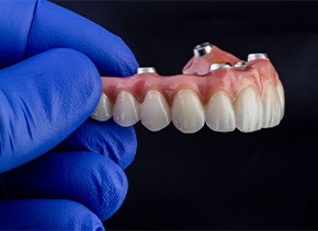 A close-up of implant-retained dentures