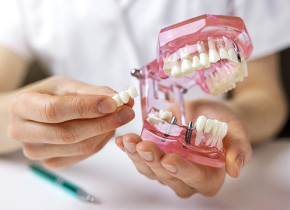 Dentist in Brooklyn placing implant bridge on model of teeth