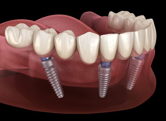 implant-retained dentures on bottom arch