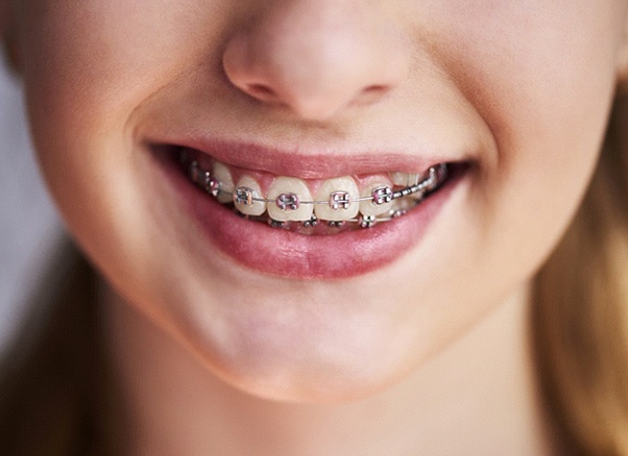 Patient with traditional braces from their Brooklyn orthodontist